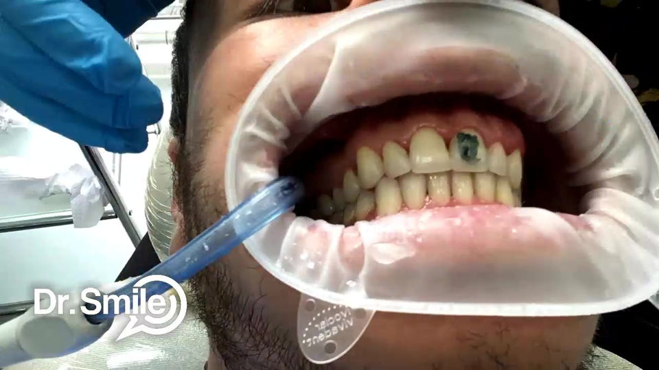 Diseño de Sonrisa en solo 3 horas